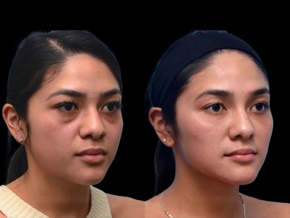 Expert Tips from the Best Aesthetic Clinic in Dubai for Treating Dark Circles