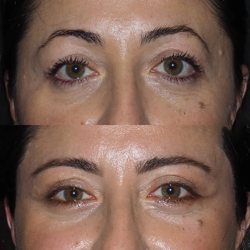 Eye Bag Removal in Dubai: Top Trending Treatments for 2026