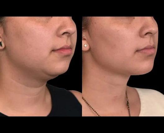 Double chin removal in Dubai: Who is an ideal candidate?