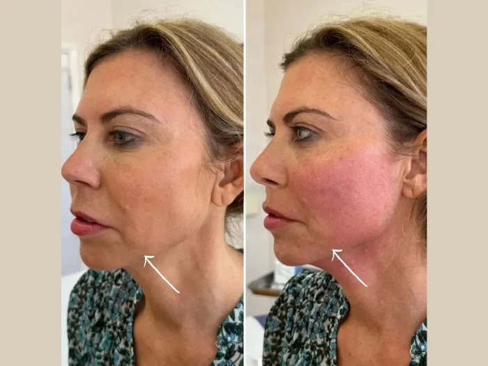 Endolift vs Surgical Facelift: Opinions from the Best Doctors in Dubai