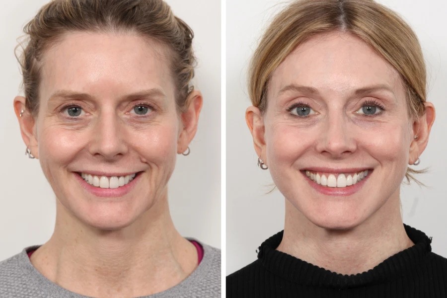 Best Aesthetic Clinics in Dubai for Thread Lift Facial Tightening