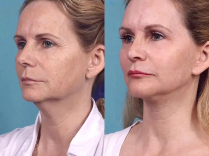 Best Aesthetic Clinics in dubai for Chemical Peels Addressing Premature Aging