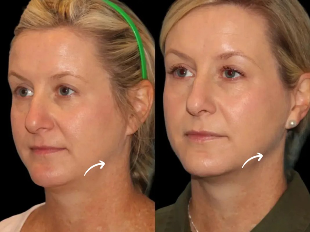Sculptra Fillers for Youthful Faces at Best Aesthetic Clinic in Dubai