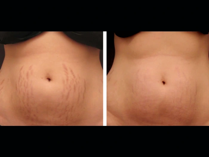 Best Aesthetic Clinic in dubai Radiofrequency (RF) Microneedling for Smooth Complexion