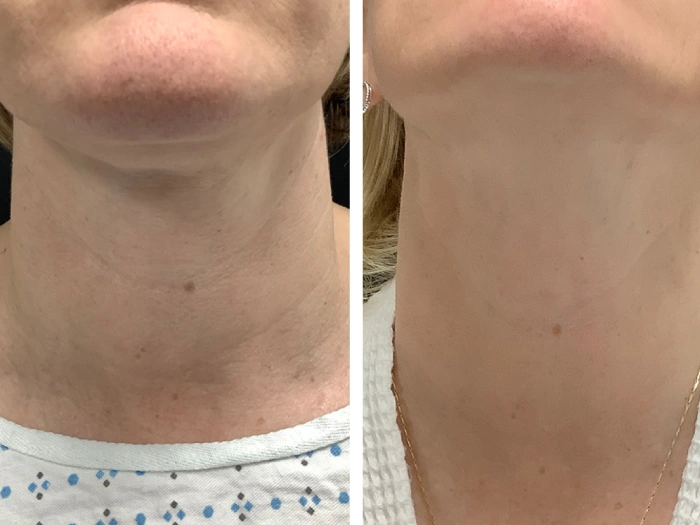 Revitalize Skin with Radiofrequency (RF) Microneedling Best Doctors in dubai