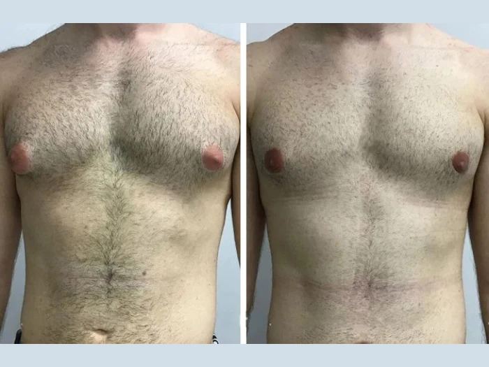 How Best Gynecomastia Doctors in Dubai Transform Male Confidence