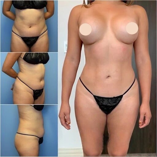 Achieving Perfect Curves: How Body Contouring Works in Dubai