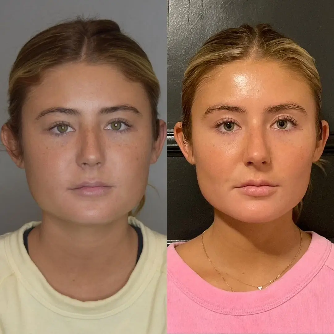 What Happens If You Regret Buccal Fat Removal in Dubai?