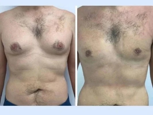 Why Patients Reviewing Results Recommend the Best Gynecomastia Surgeons in Dubai