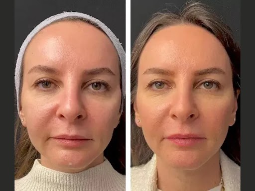 Best Doctors in Dubai for Mesotherapy Treatment: How to Choose