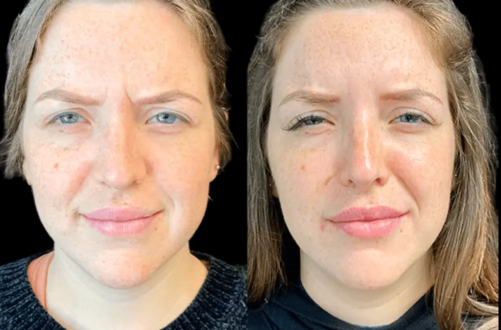 Preventive Care Explained: The Rise of Early Botox Treatments in Dubai