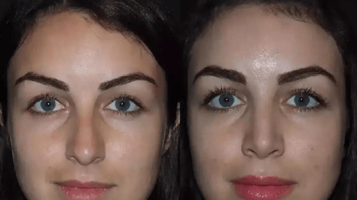 Rhinoplasty in Dubai: Balancing Cultural Identity with Personal Aesthetic Goals