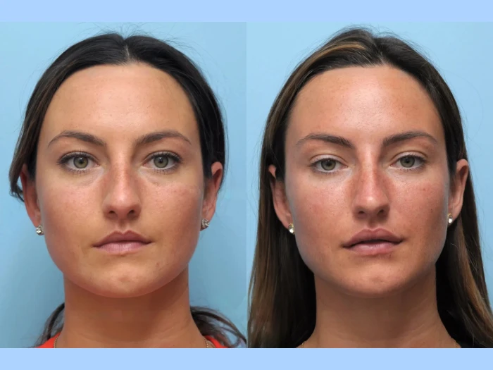 Achieve Noticeable Natural Results at the Best Aesthetic Clinic in Dubai for Thread Lift