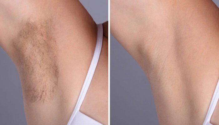 Best Aesthetic Clinic in dubai: For Reliable Laser Hair Removal Results