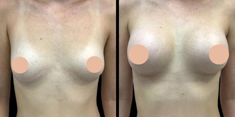 Best Doctors in Dubai for Teen and Young Adult Breast Augmentation Guidance