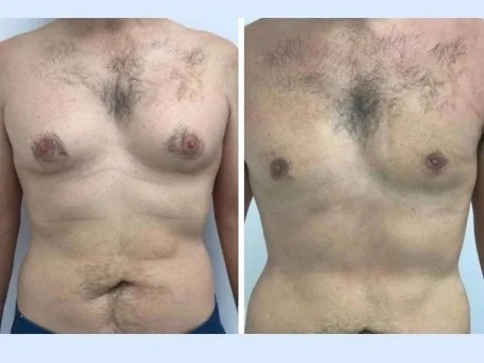 Best Doctors in Dubai for Gynecomastia: Support Groups and Resources