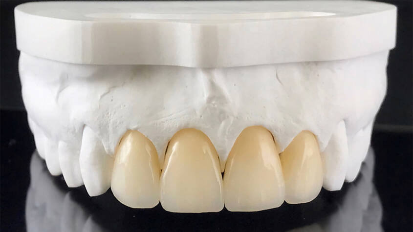 Zirconia Crown Dubai: Durable, Natural-Looking Dental Restorations